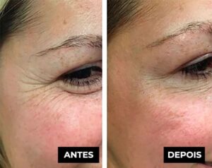 Creme Lifting Firmador Remover Rugas em 60 segundos