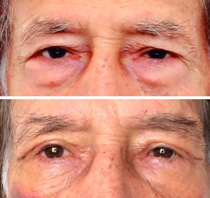 Creme Lifting Firmador Remover Rugas em 60 segundos